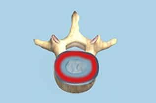 Get today Decompressive Laminectomy by Dr Surya Prakash Rao, Top Spine Surgeon Hyderabad