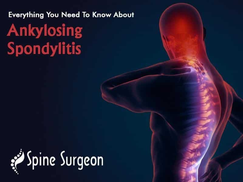 Everything You Need To Know About Ankylosing Spondylitis