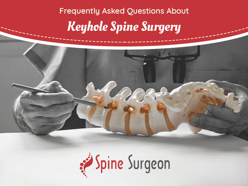 Frequently Asked Questions About Keyhole Spine Surgery