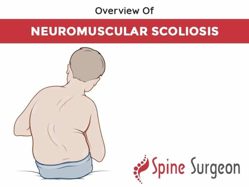 Overview Of Neuromuscular Scoliosis Spine Surgeon overview-of-neuromuscular-scoliosis-spine-surgeon